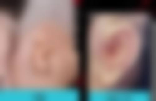 瘦脸针100单位够打两边吗