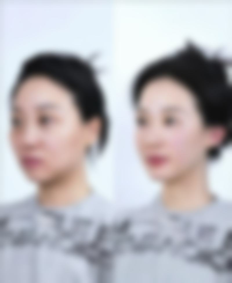 打完瘦脸针后，还有这些注意事项