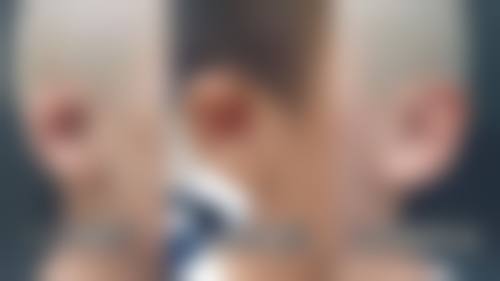 咬肌嘴歪矫正的相关资源