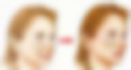 咬肌嘴歪矫正的注意事项