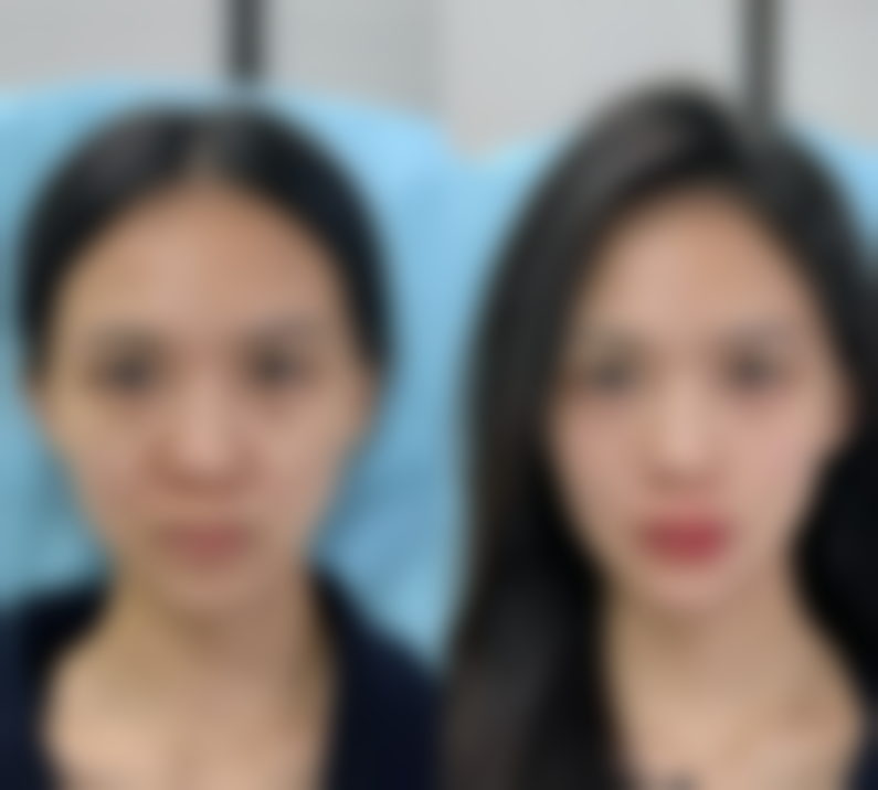 大麦植发一般需要多少钱