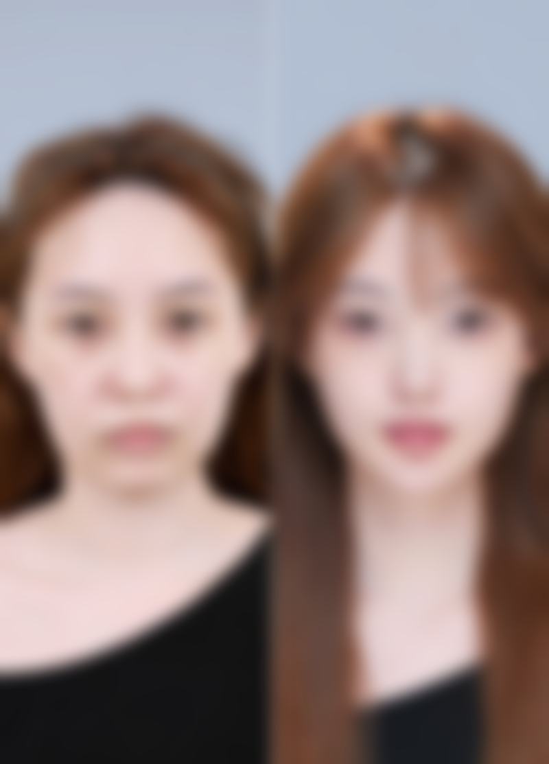 瘦脸针打完注意事项