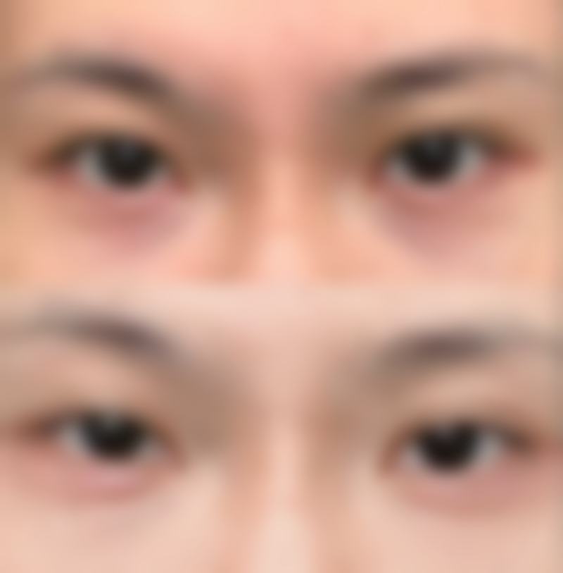 除皱针的危害和副作用有哪些