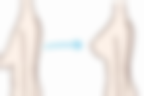 除皱针几天见成效