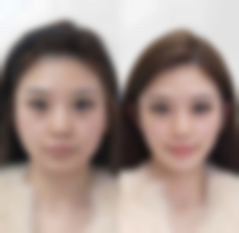 种植的头发会越长越密吗？