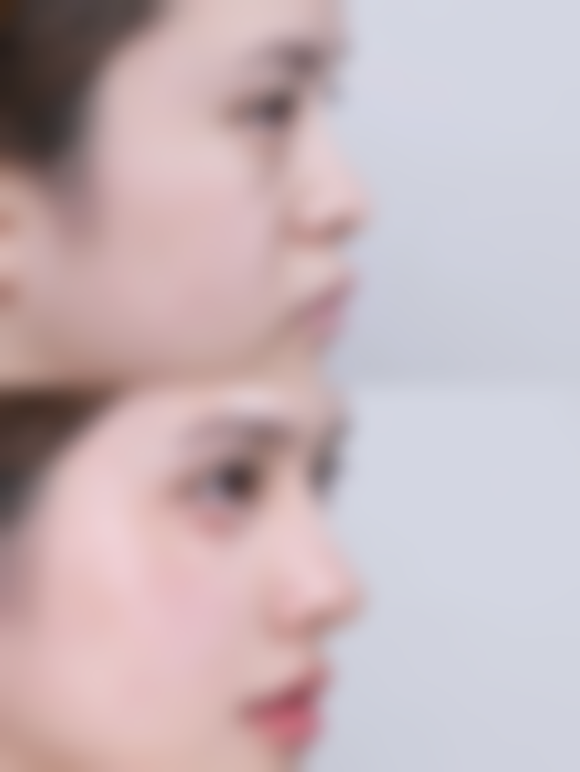 种植的头发完全存活生长要多长时间？