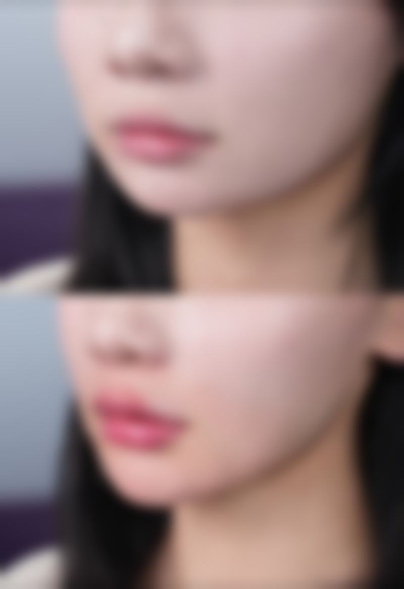 在美容院打的瘦脸针管用吗