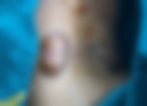 经常打瘦脸针的危害有什么后遗症