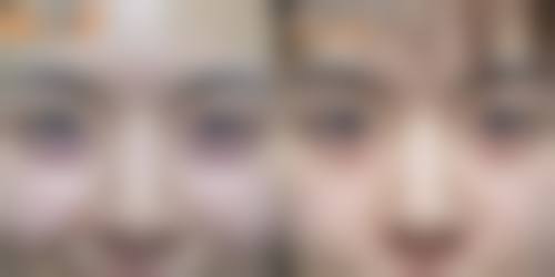 不同价格除皱针的情况