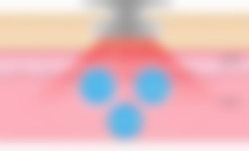 经常打瘦脸针对脸好吗