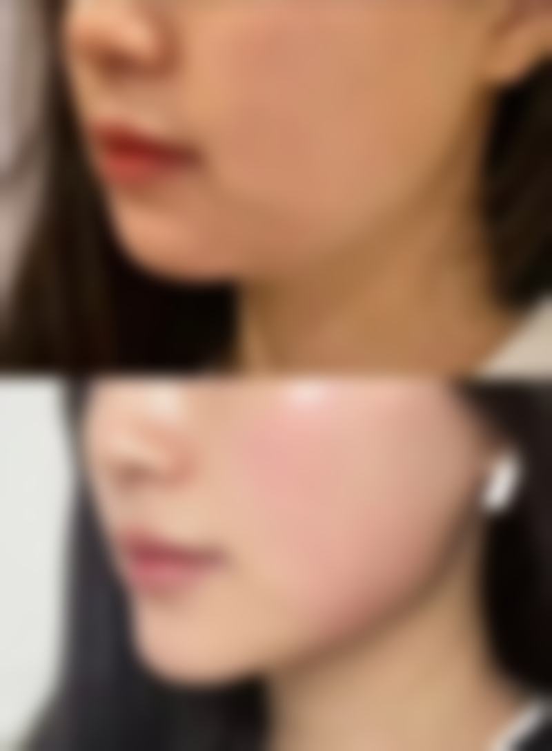 经常打瘦脸针的危害有什么症状