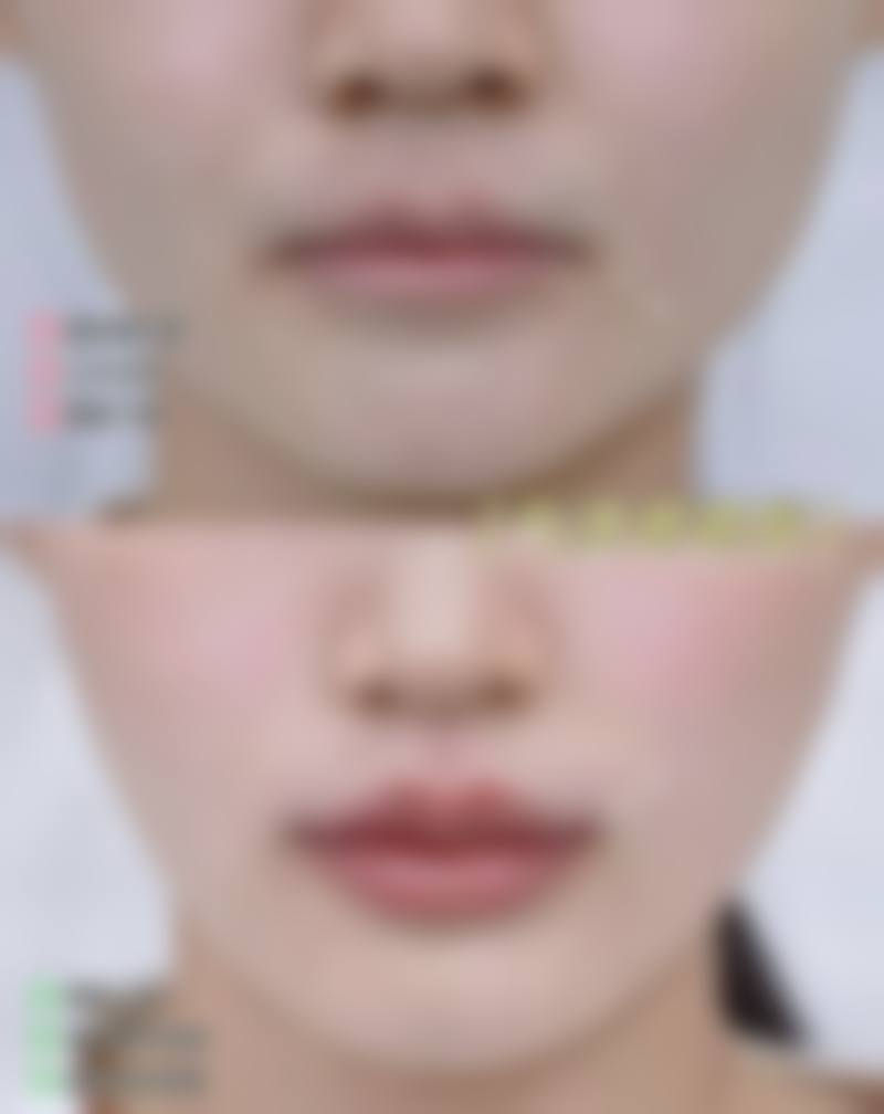 经常打瘦脸针好吗打瘦脸针安心吗