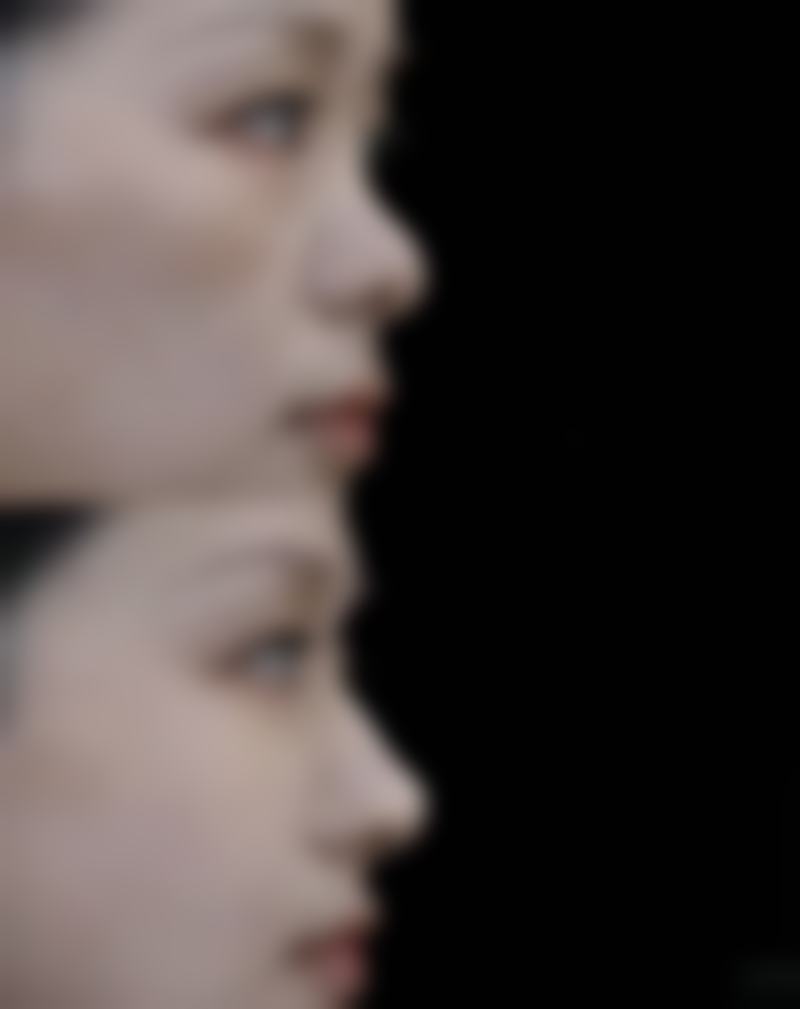 自体脂肪移植丰太阳穴的优缺点