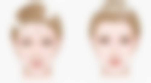 激光除疤痕成效怎么样