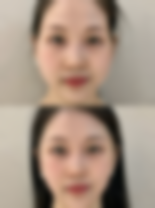 激光除皱成效好不好