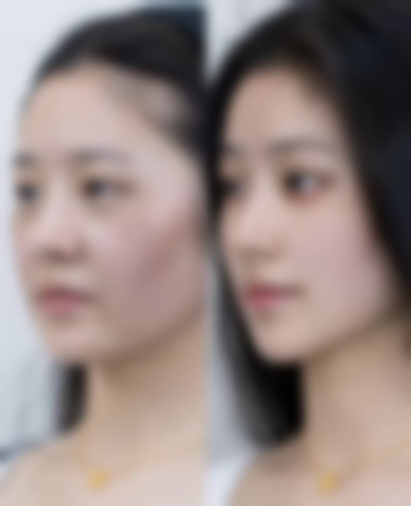 保妥适瘦脸针至佳成效多久