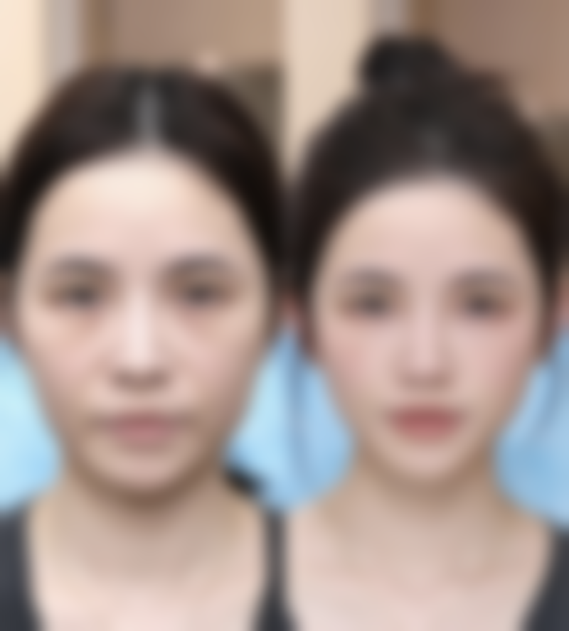 除皱针的价格一般是多少