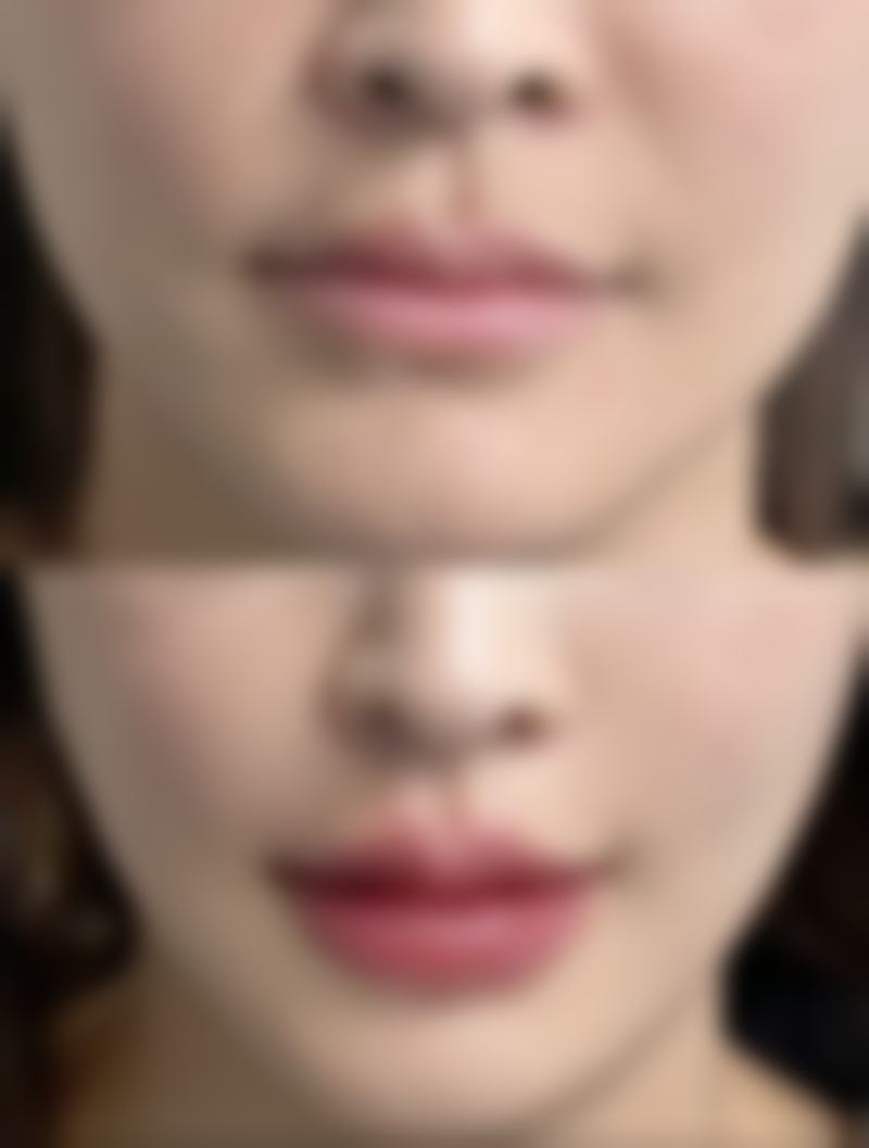 除皱针一年打几次更好