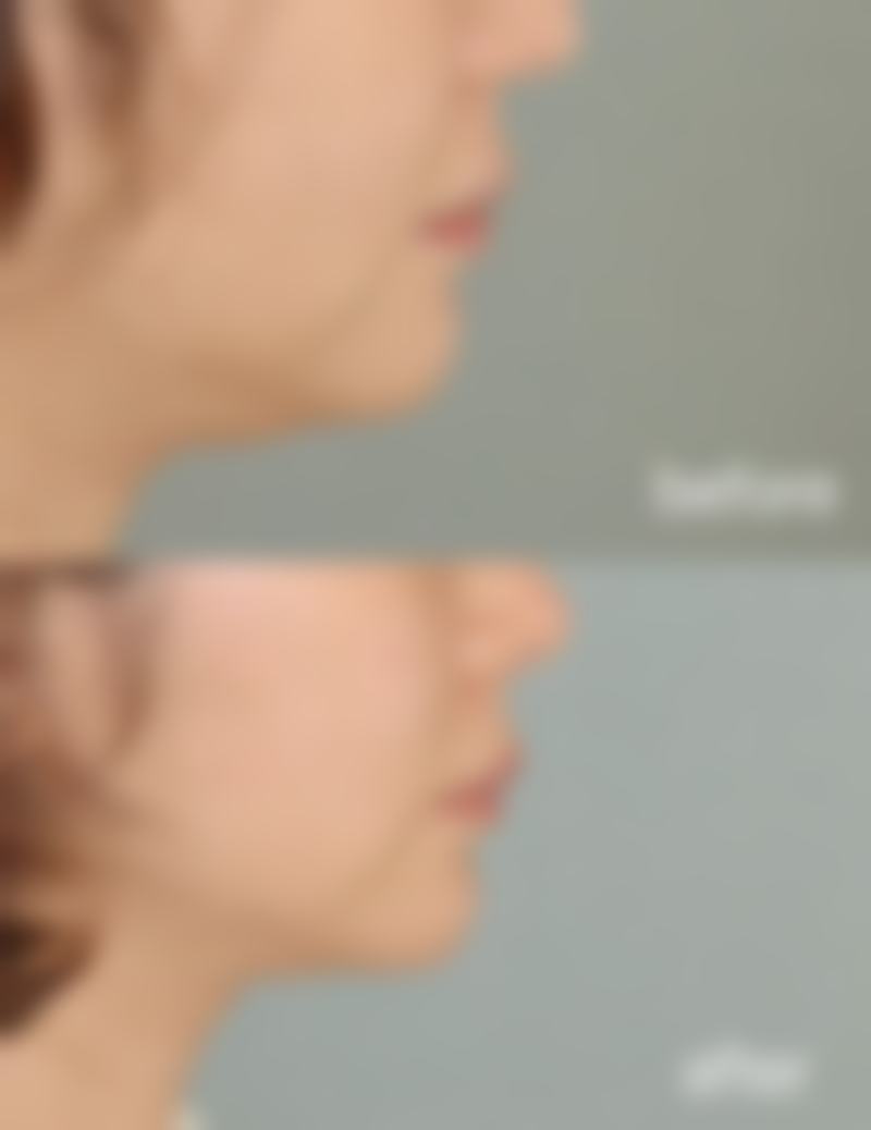 胖的时候打瘦脸针好，还是瘦的时候打?