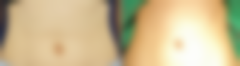 打了瘦脸针多久可以打九价疫苗