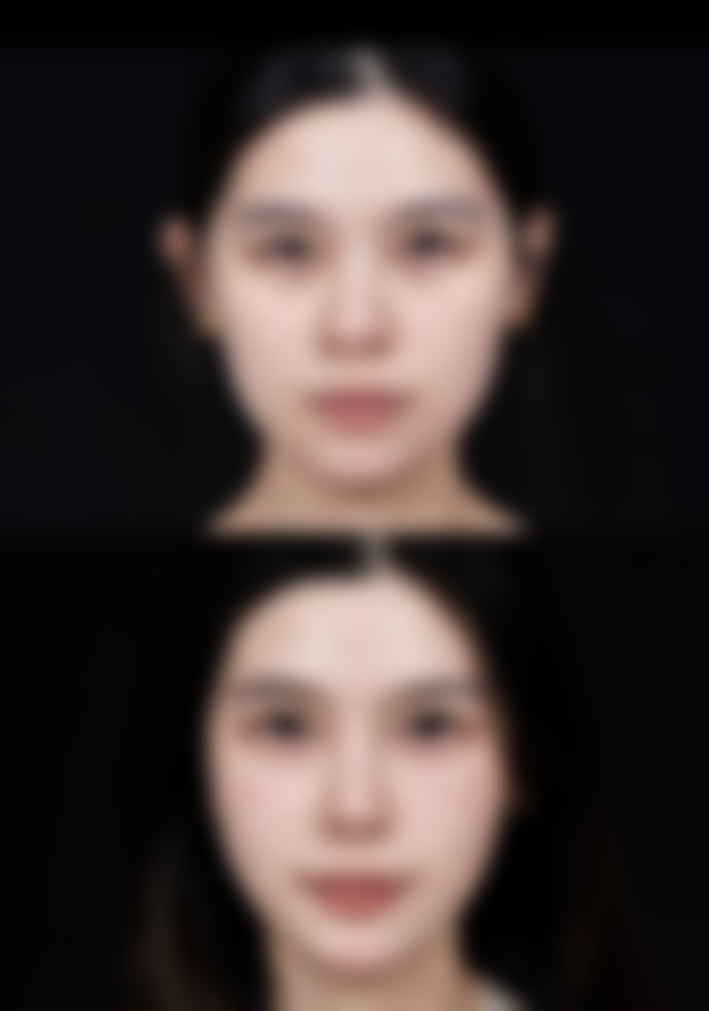 除皱针一般多久打一次更好