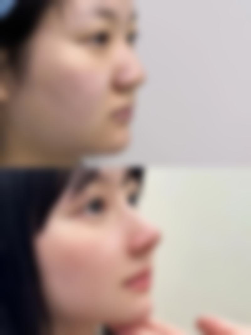 埋线去皱纹有副作用吗