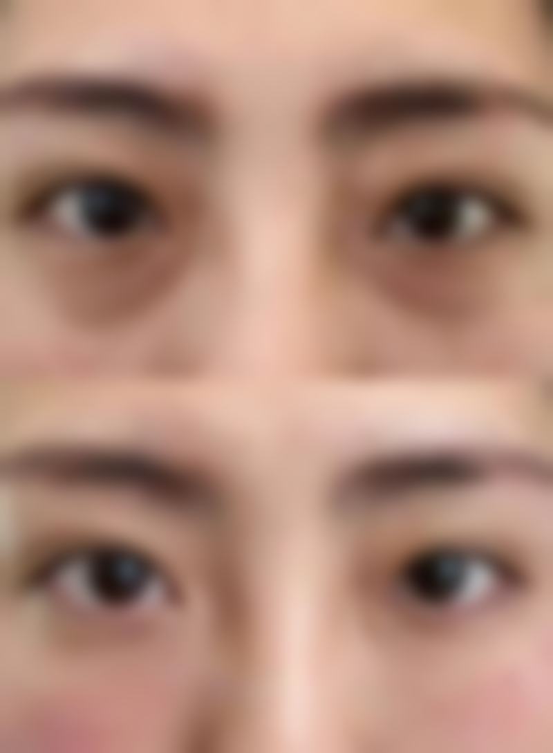 自体脂肪填充的常见问题解答