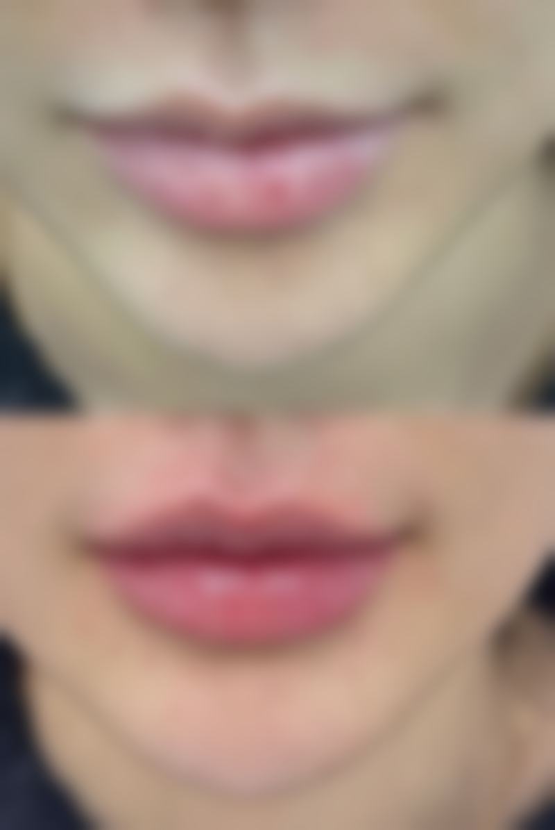 自身脂肪填充有后遗症吗