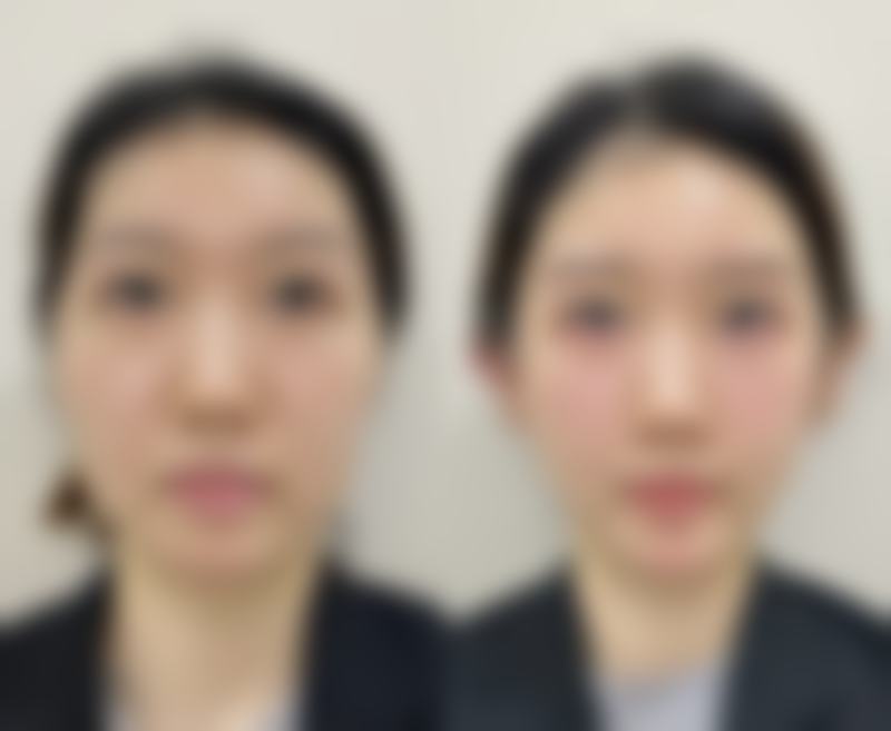 脸肥胖打瘦脸针是否有用