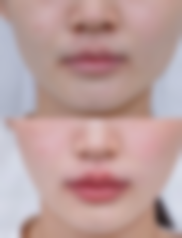 除了手术，嘴唇厚还有其他变薄的方法吗