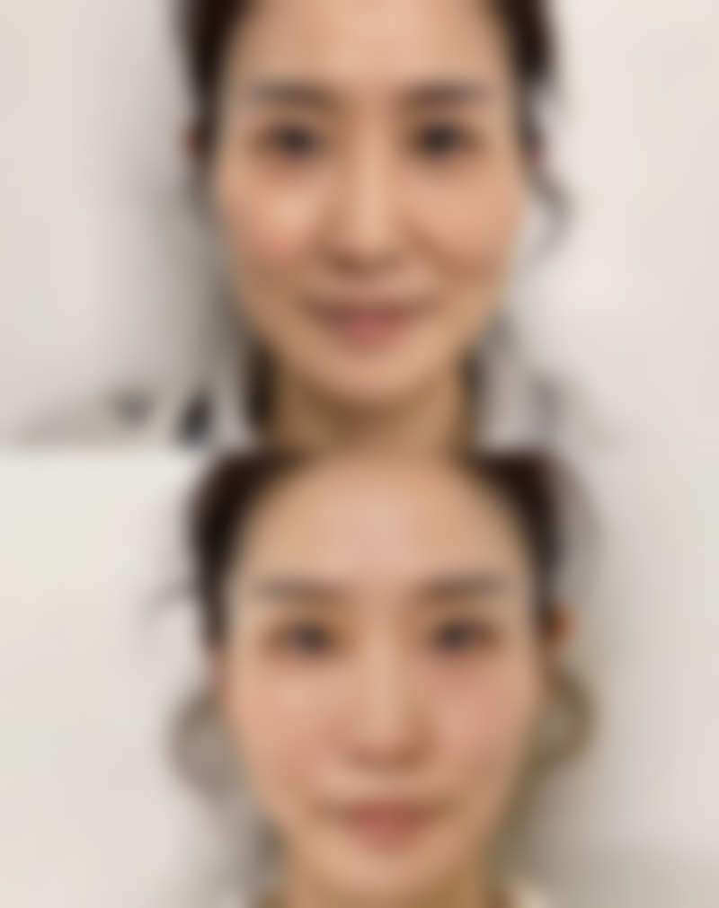 下颌角整形术要多少钱？