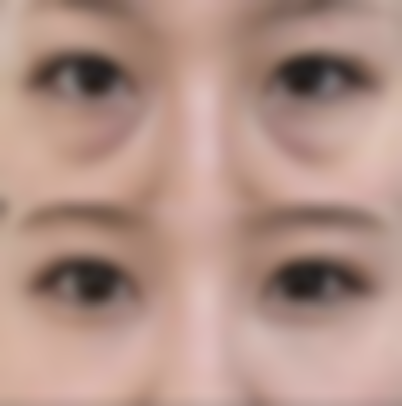 为什么有人说厚唇改薄一年后又厚了