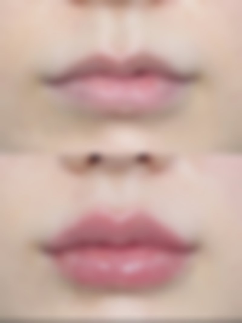 阴道膨出做盆底肌有用吗