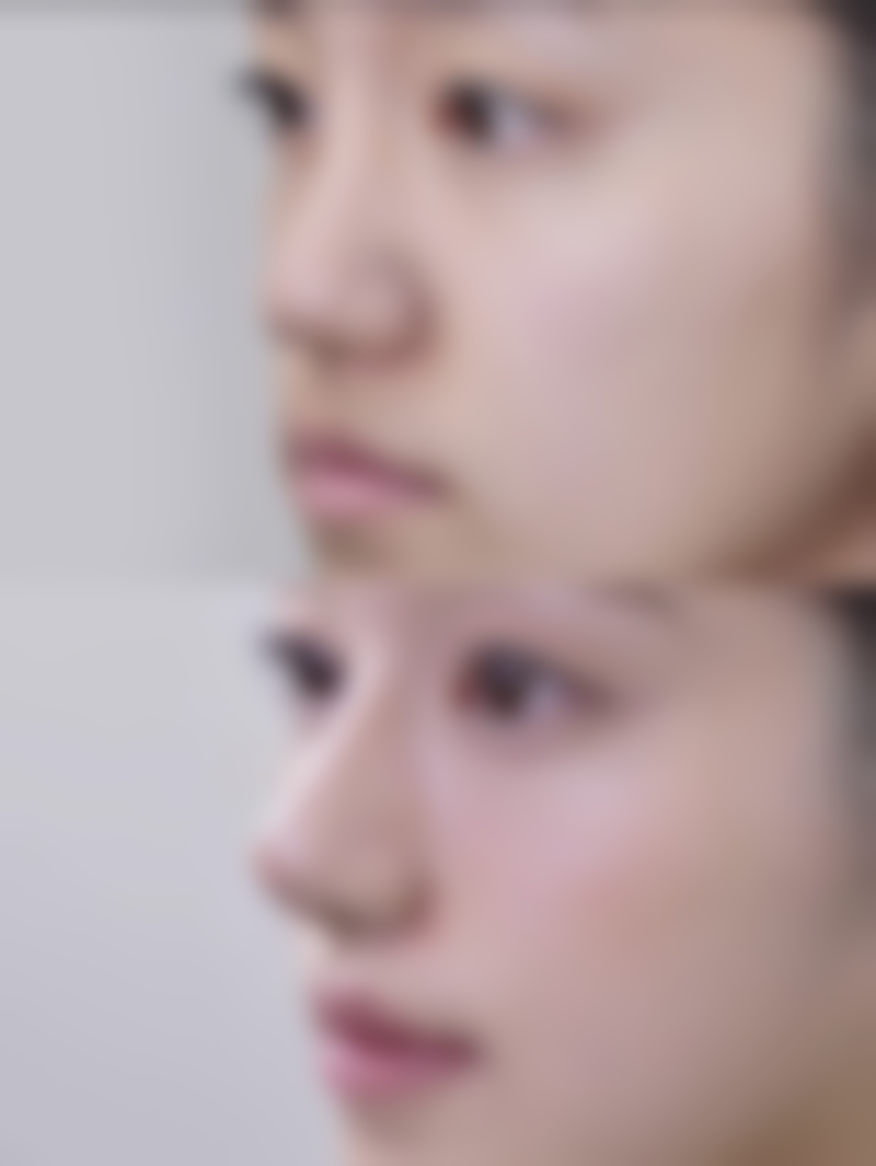 自体脂肪丰臀可以维持多久