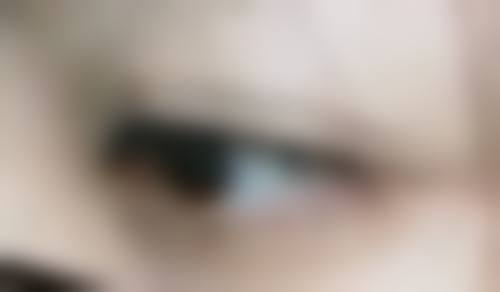 种植头发有什么风险和后遗症