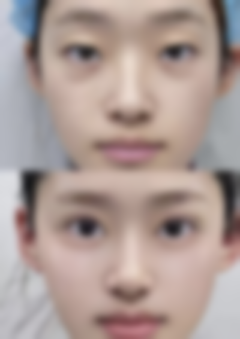 瘦脸针真的成效好吗