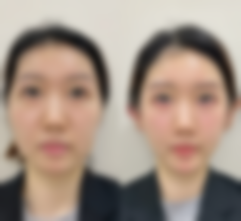 嘴巴改小整形视频过程及改小图片、缝针照