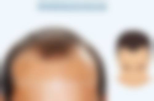 美白针真的能全身美白吗