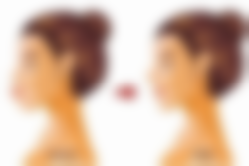 女生关注的美白针问题