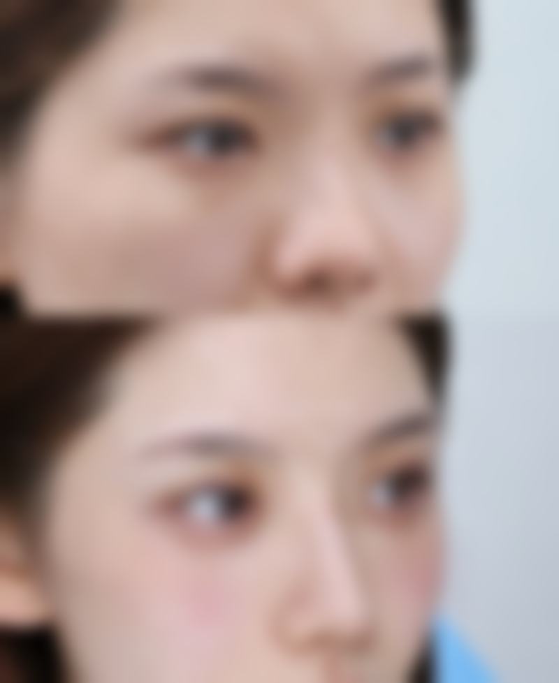 瘦脸针半月了为什么没瘦呢