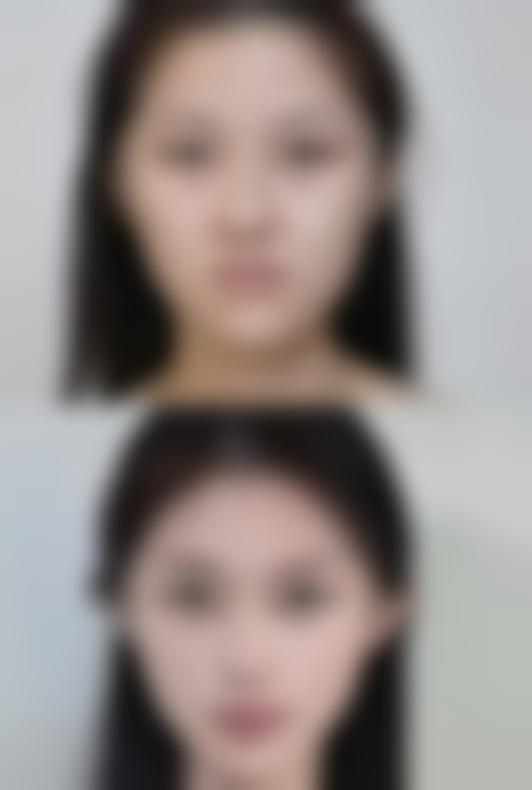 瘦脸针哪里打比较正规