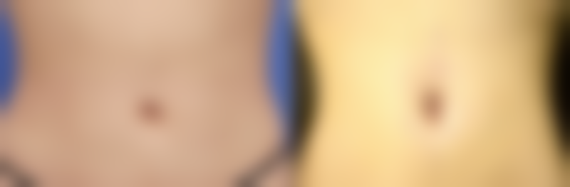 打瘦脸针半月了没成效怎么办