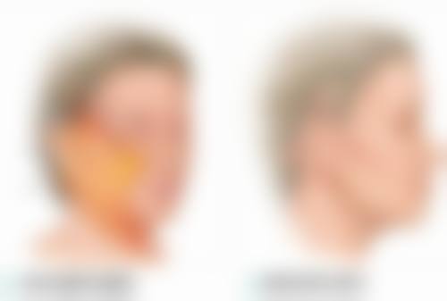 如何延长瘦脸针的成效