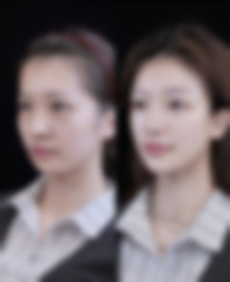 瘦脸针一针注射法