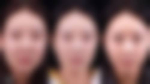 脸部下垂打瘦脸针有用吗