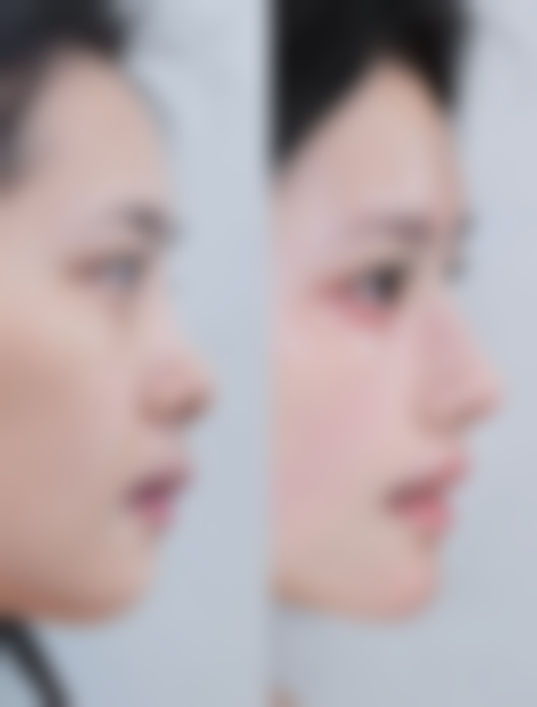 种植头发有没有副作用