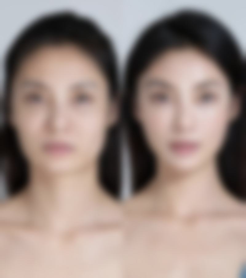 注射瘦脸针的后遗症有哪些？