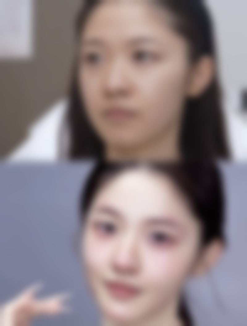 打完瘦脸针多久可以平躺