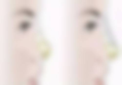 长期打瘦脸针会怎么样