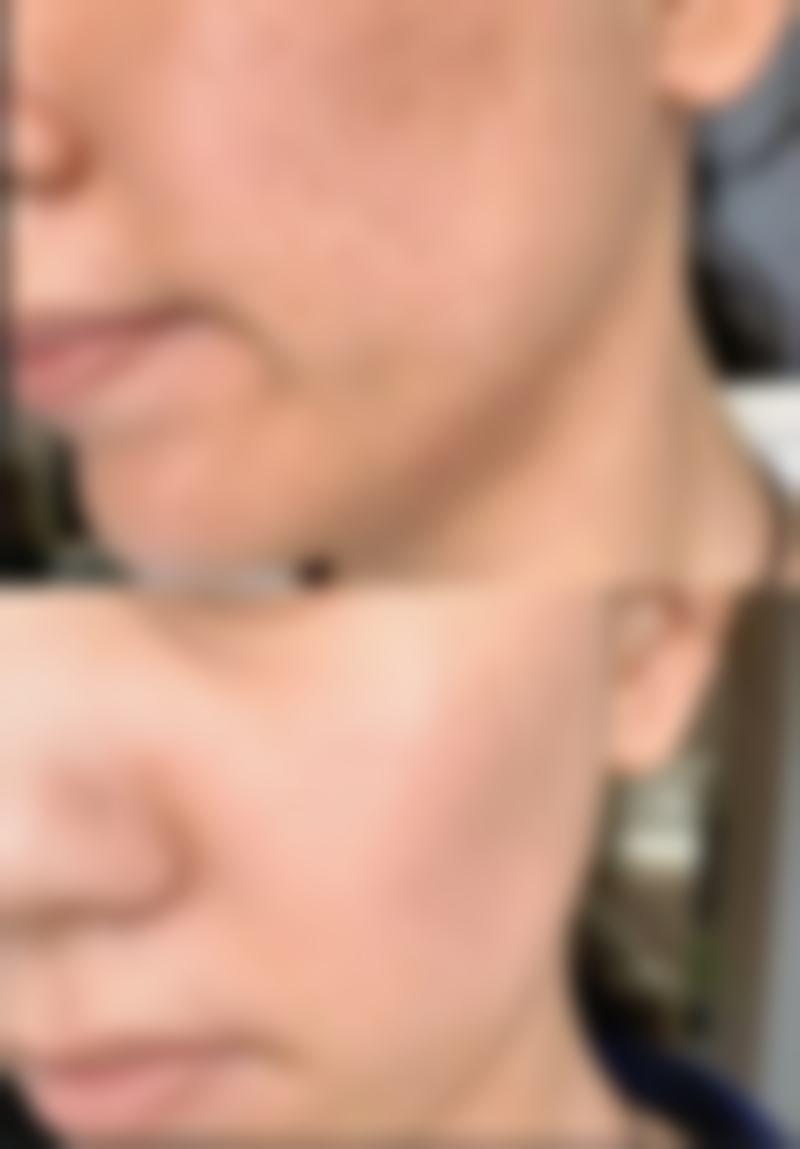 头发种植的危害及解决办法